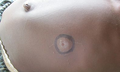 Kleine Knoten in der Haut sind die ersten Symptome.