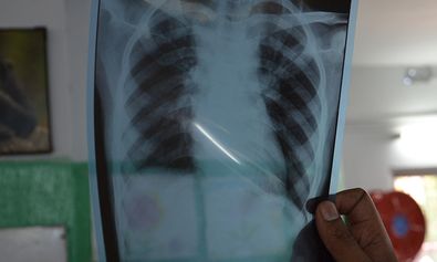 Tuberkulose kann durch Röntgen in der Lunge entdeckt werden. 
