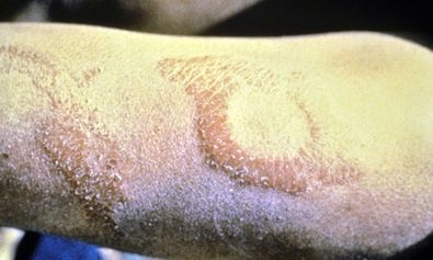 Charakteristisch für die tuberkuloide Lepra sind wenige, runde und asymmetrisch verteilte Farbveränderungen der Haut mit begleitenden Empfindungsstörungen, dem Ausbleiben von Schweiß und isolierten, spürbaren Auftreibung äußerer Nerven.
Foto: DAHW