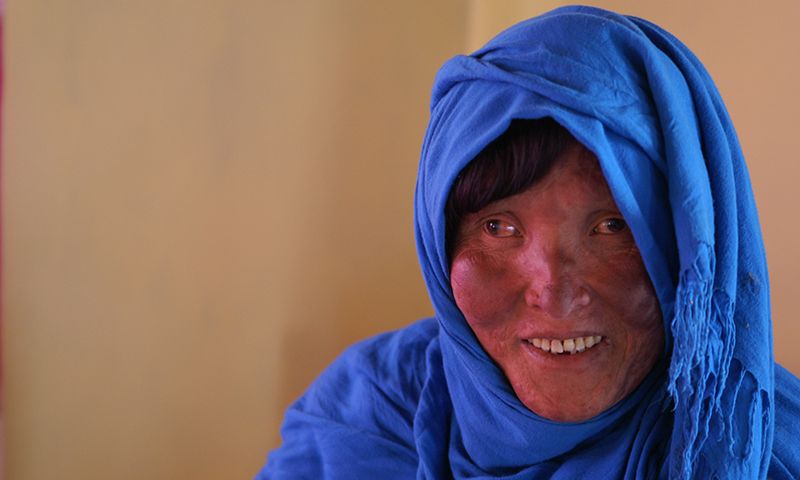 Zahara I. wird nie über ihre Erkrankung sprechen. Ihr Ehemann würde sie verstoßen. Sie sagt, sie hätte eine Hauterkrankung, die behandelt werden muss.
Foto: Sabine Ludwig / DAHW