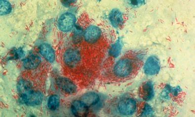 Massenhafte Darstellung (rotgefärbter) Mycobacterium leprae im Ausstrich - Färbung nach Ziehl-Neelsen 