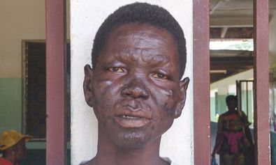 Patient mit Lepromatöser Lepra, Liberia 2013.